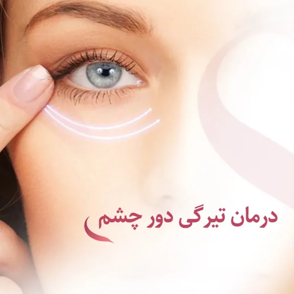 تیرگی دور چشم