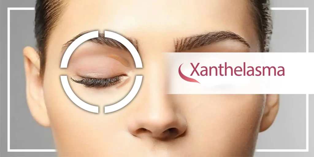 گزانتلاسما چیست؟ تشخیص، نحوه درمان و تصاویر 17 گزانتلاسما